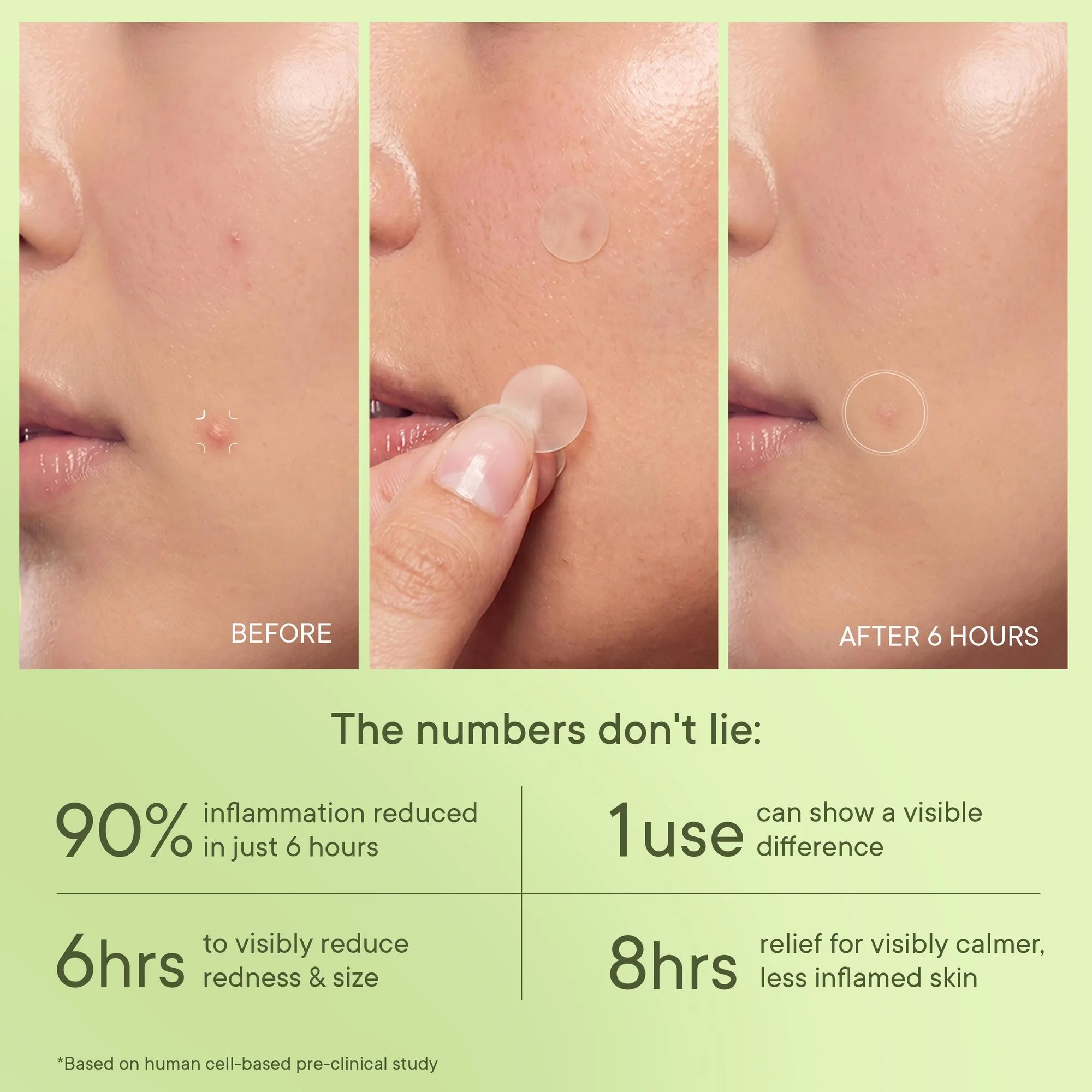 Zit Away Treatment Patches with Cica Herb Repair - 24 PATCHES - Image 6